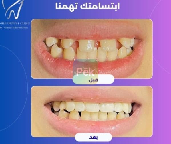 دكتور تجميل أسنان في الغربية - إبتسامة هوليود